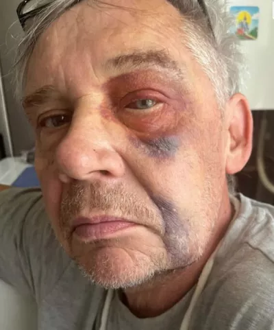 У Радомишлі чоловік місяцями лікується після ДТП, але у справі досі залишається свідком